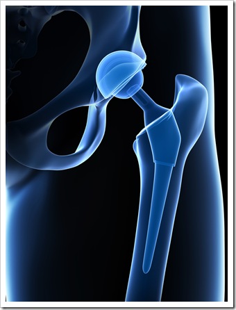 Back Pain Ventura CA Joint Replacement