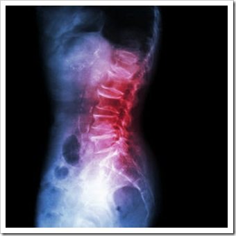 Back Pain Ventura CA Arthritis