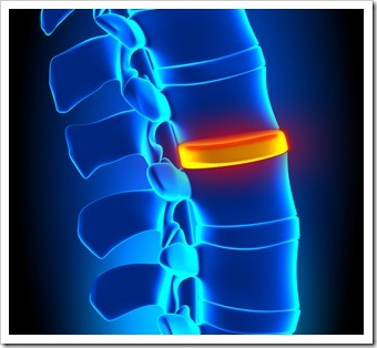 Herniated Disc and Back Pain Ventura CA