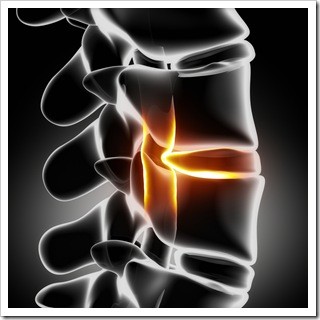 Slipped Disc Ventura CA