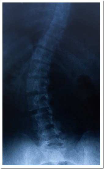 Ventura CA Scoliosis Treatment